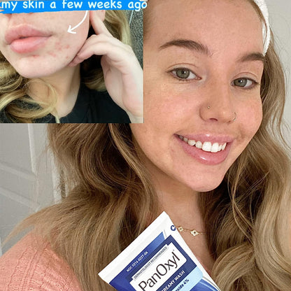 PANOXYL ACNE FOAMING WASH 4%