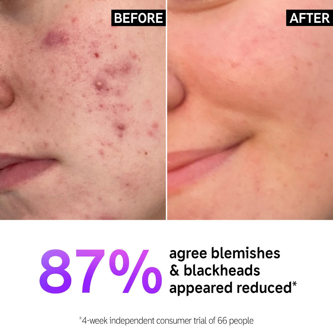 Salicylic Acid Acne + Blackhead Cleanser - The Inkey List