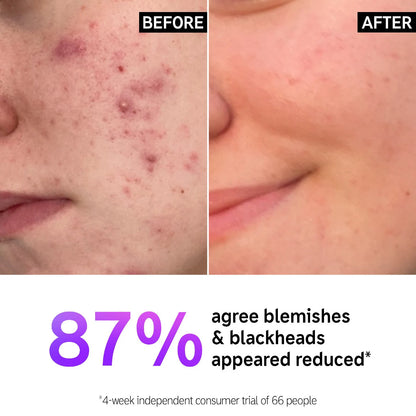 Salicylic Acid Acne + Blackhead Cleanser - The Inkey List