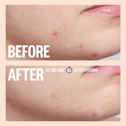 Salicylic Acid Acne Healing Dots - Peace Out