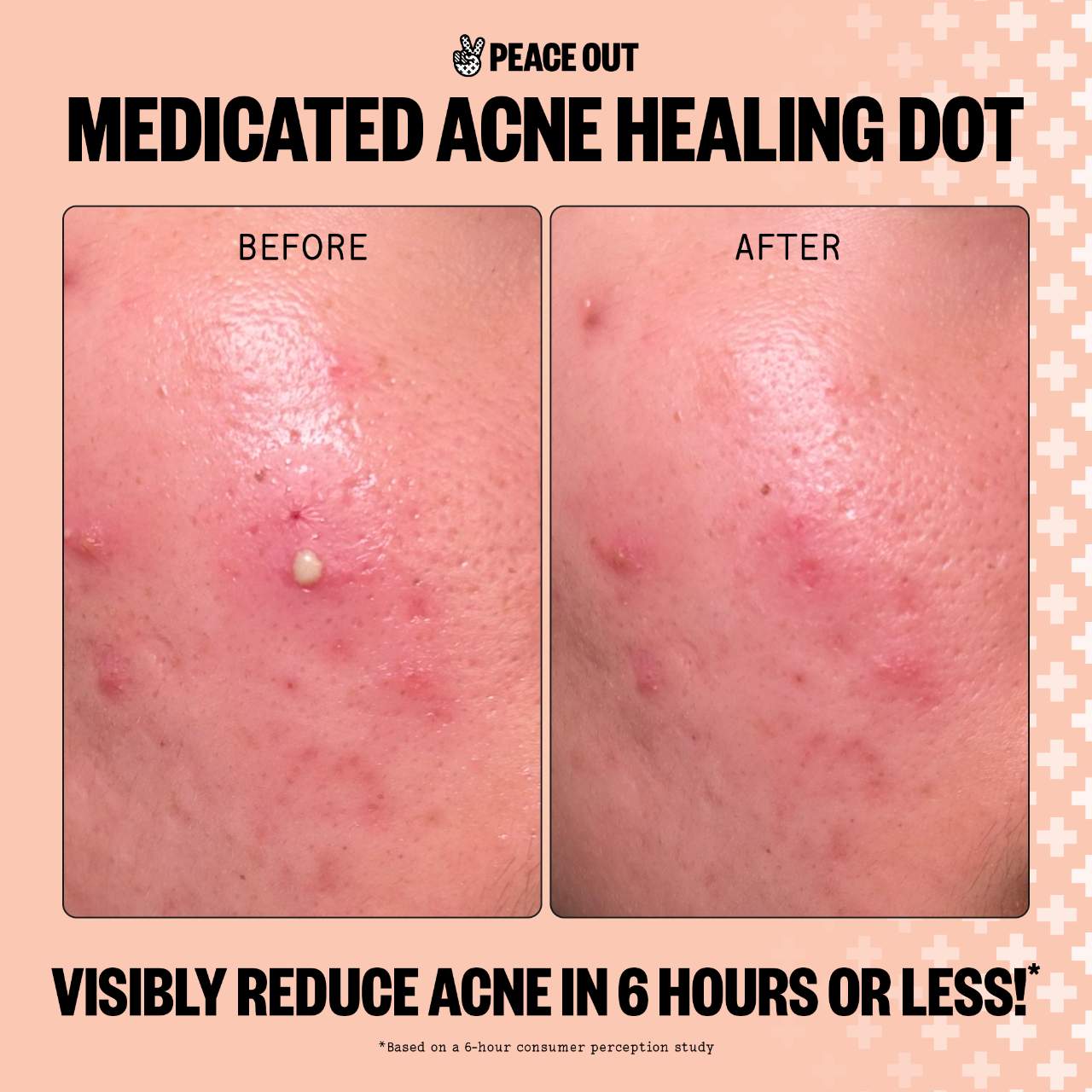 Salicylic Acid Acne Healing Dots - Peace Out