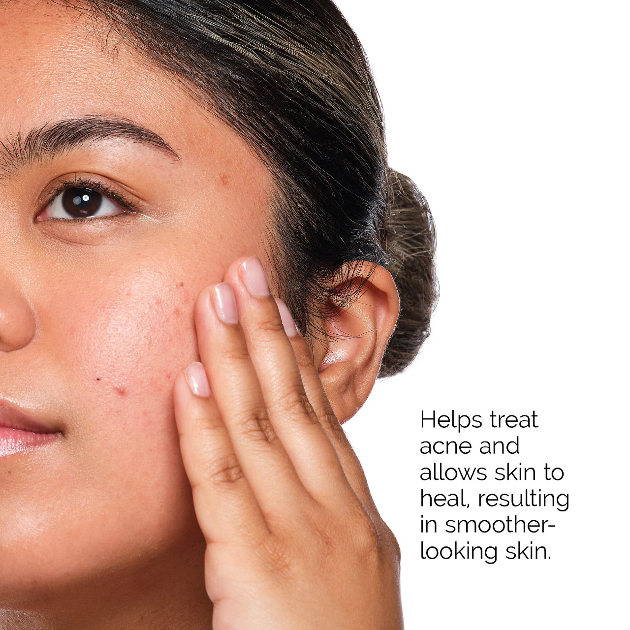 The Acne Set - The Ordinary